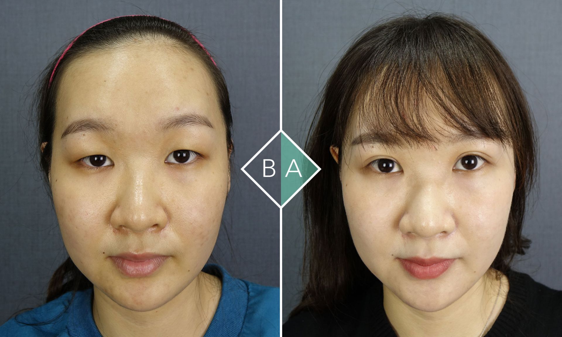 術後的Phoebe看起來更有神了。