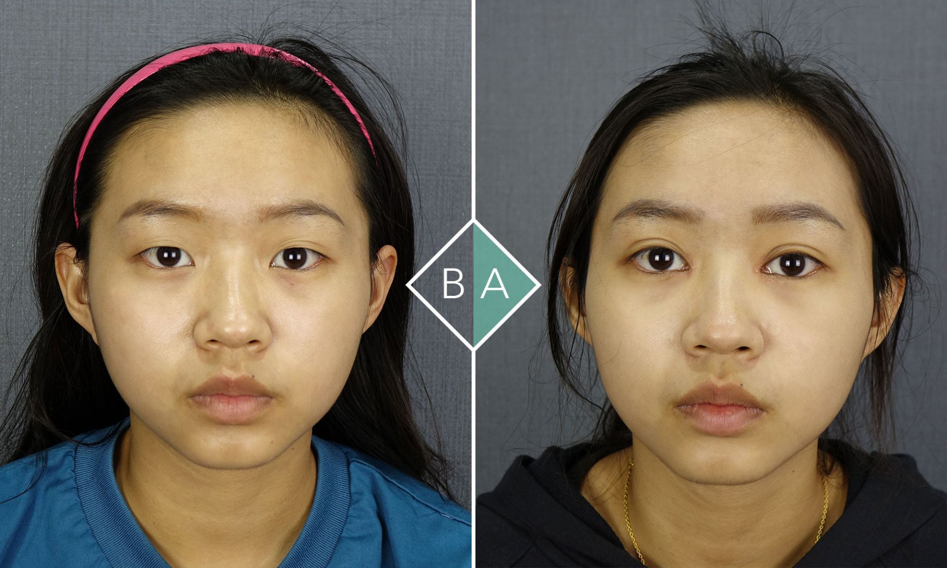 術後大眼的Zoe，成了電眼美女。