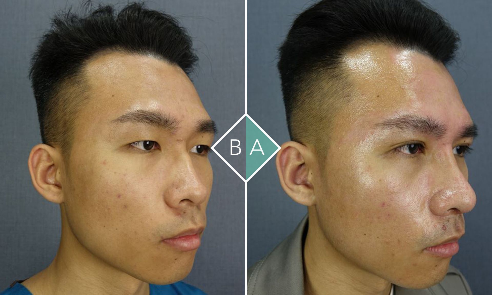 術後的Jack五官看起來更有神了