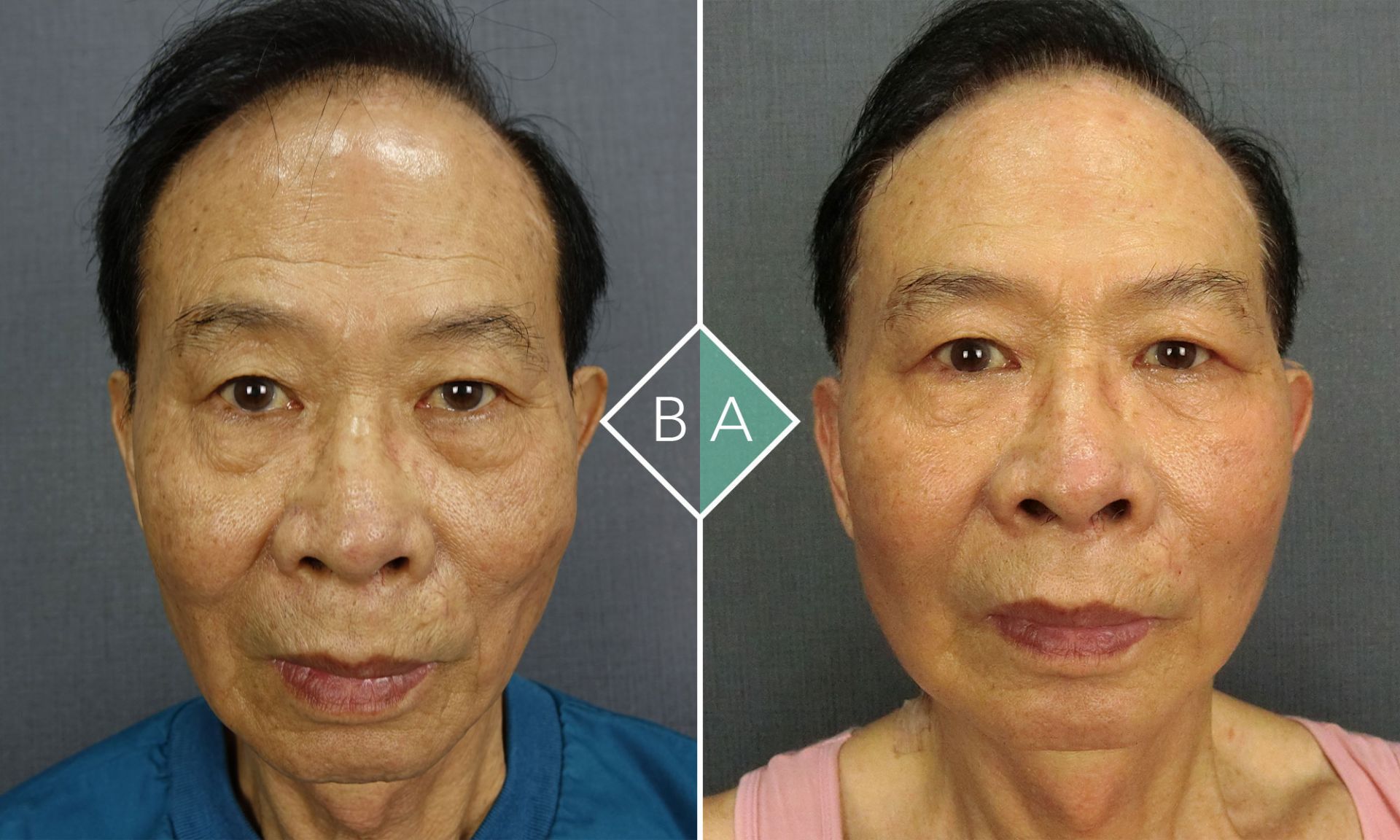 術後的林先生,皮膚更加緊緻,人也更有元氣