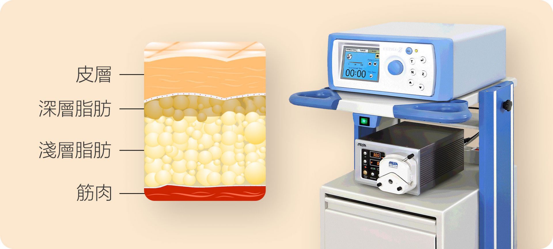 超音波抽脂作用原理