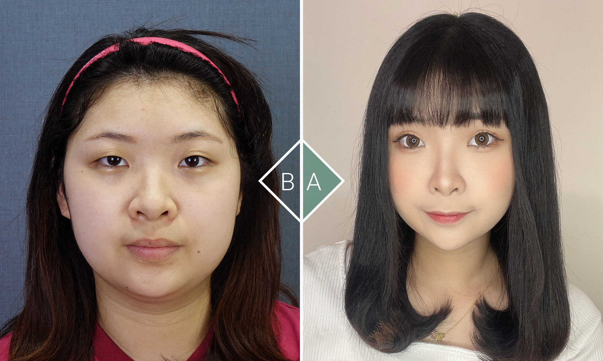 雙眼皮創造新自信：優雅迎接全新自己