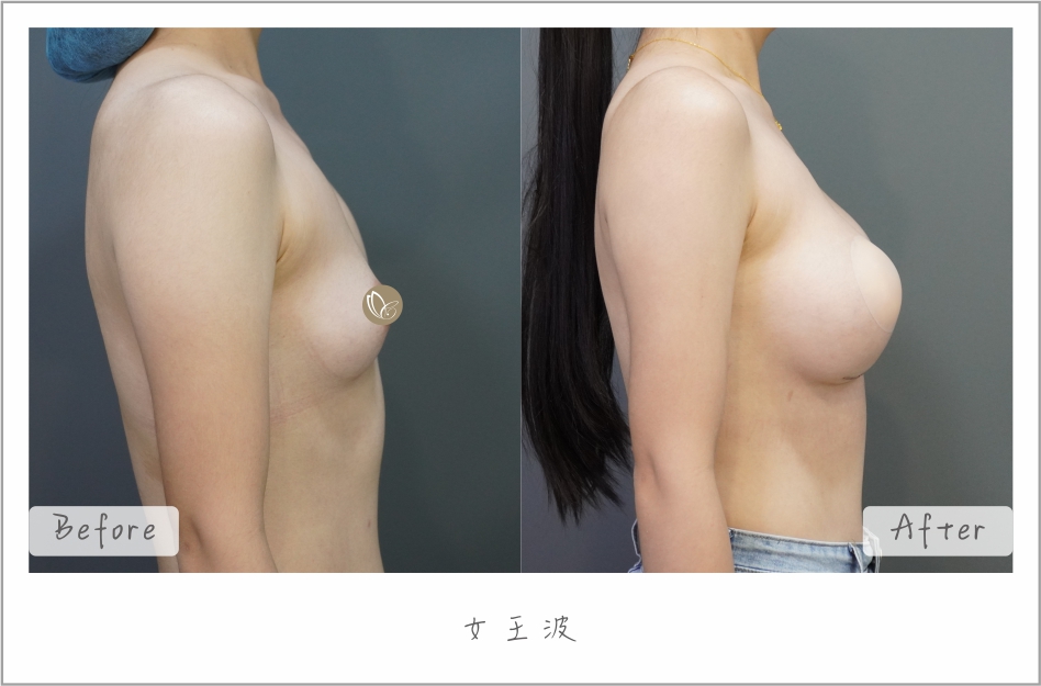 女王波隆乳 案例