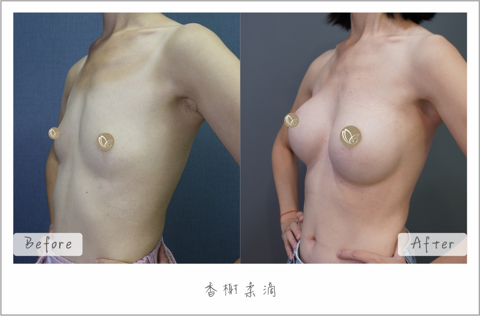 香榭柔滴｜隆乳案例