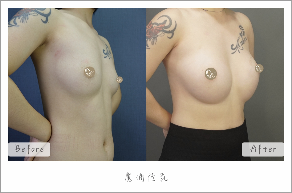 魔滴隆乳｜隆乳案例