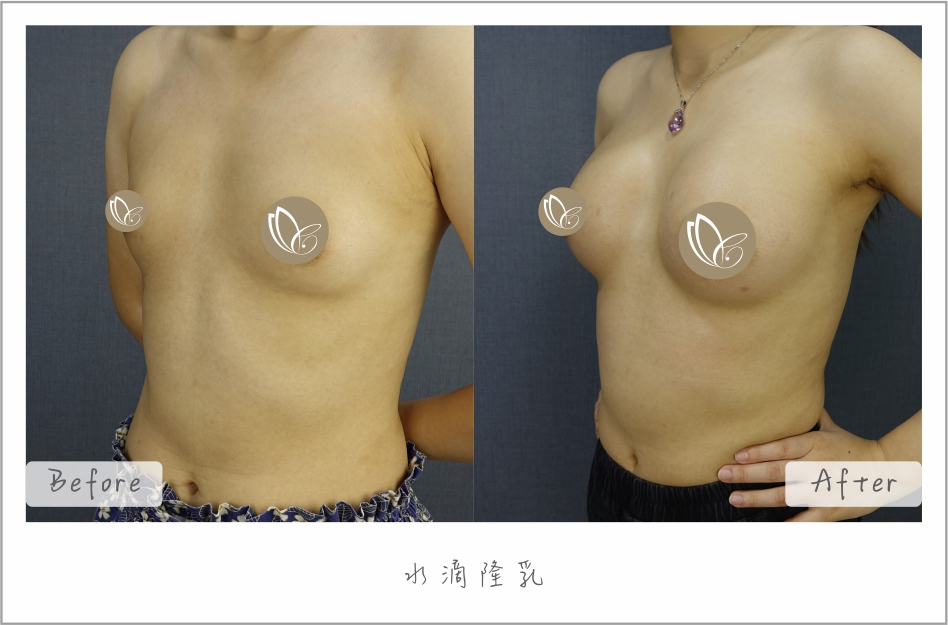 水滴隆乳｜隆乳案例