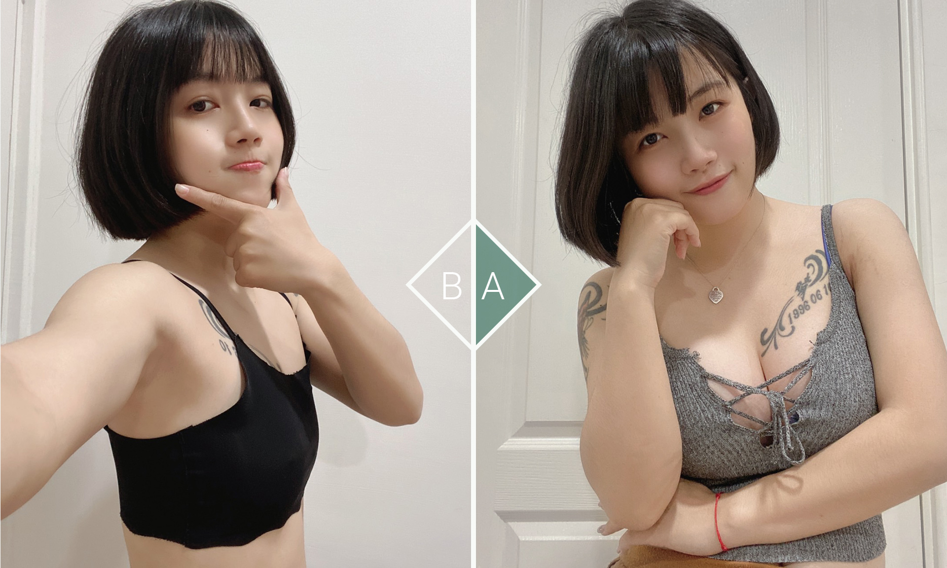 魔滴｜隆乳案例