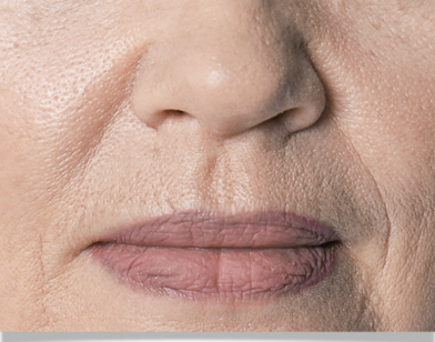 法令紋與口周皺紋示意