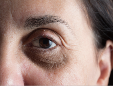 眼周細紋與鬆弛示意