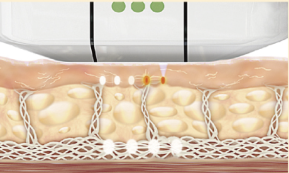 Ulthera 微聚焦超音波作用示意圖
